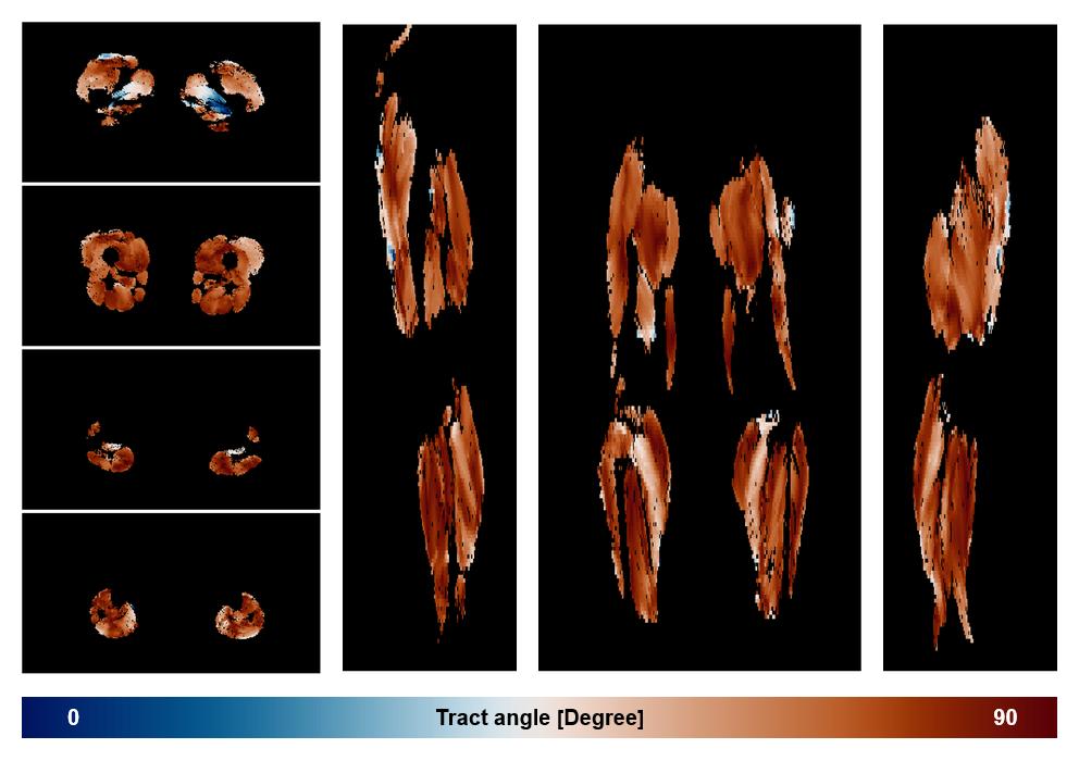 Muscle fiber tract angle map based on whole leg DTI based fiber tractography.