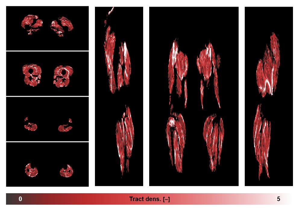 Muscle fiber tract density map based on whole leg DTI based fiber tractography.