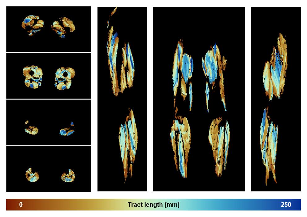 Muscle fiber tract length map based on whole leg DTI based fiber tractography.