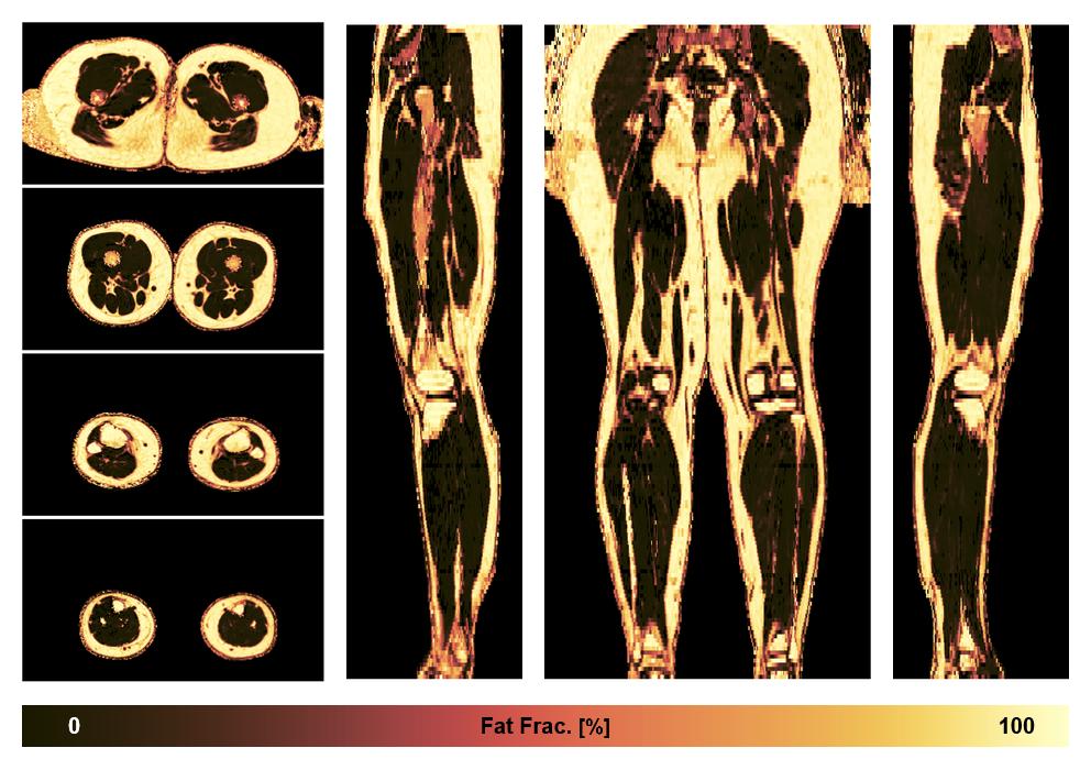 The fat fraction of the lower extremity obtained from the dixon reconstruction for muscle water fat quantification.
