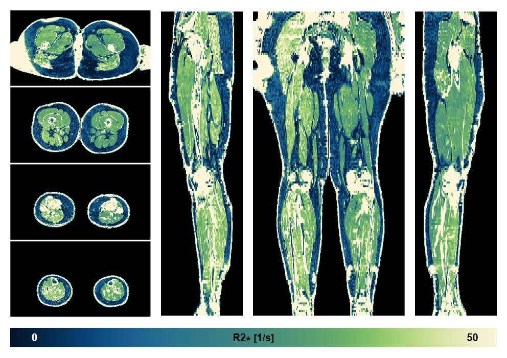 The R2 star relaxation time of the lower extremity obtained from the dixon reconstruction for muscle water fat quantification.