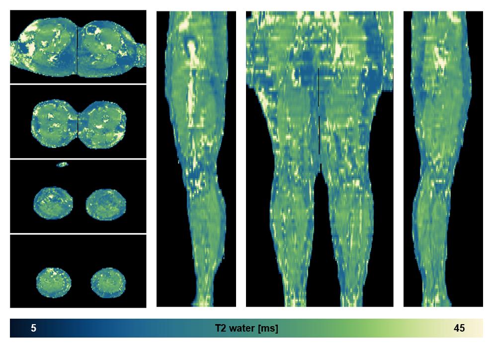 The water only T2 relaxation time of the lower extremity obtained from multi echo spin echo t2 mapping with EPG based reconstruction.