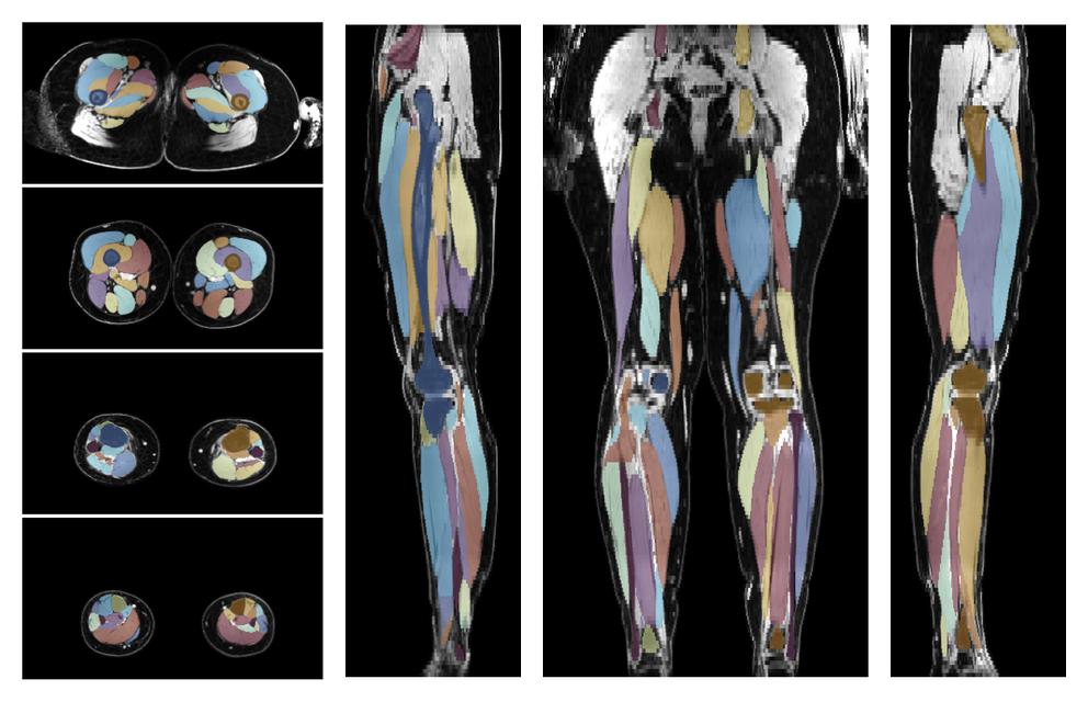 Overlay of automated muscle segmentation labels on dixon water image.
