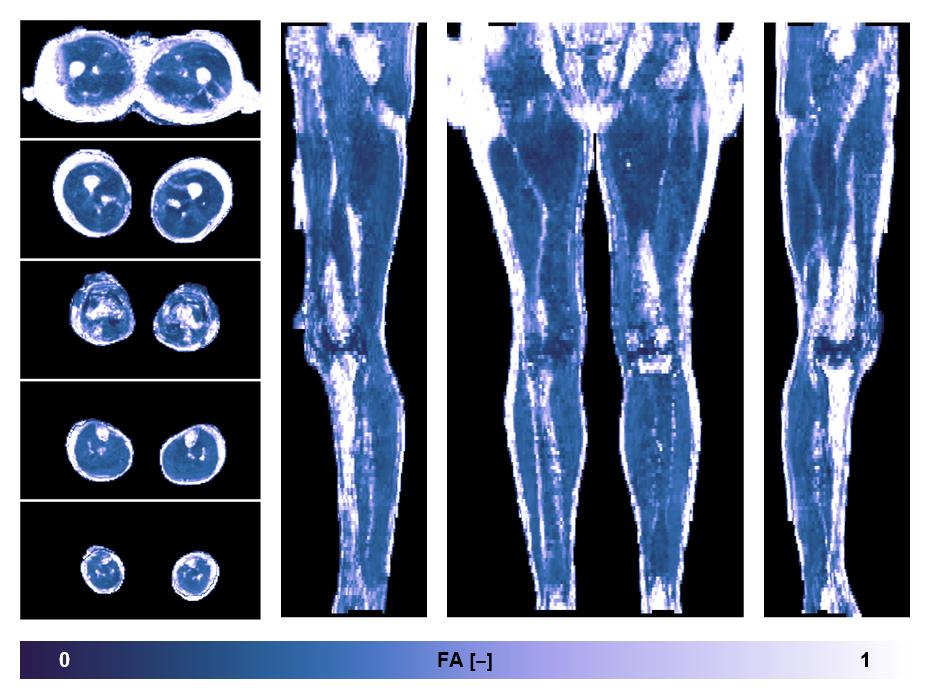 IVIM corrected whole leg muscle fractional anisotropy obtained from diffusion tensor imaging.