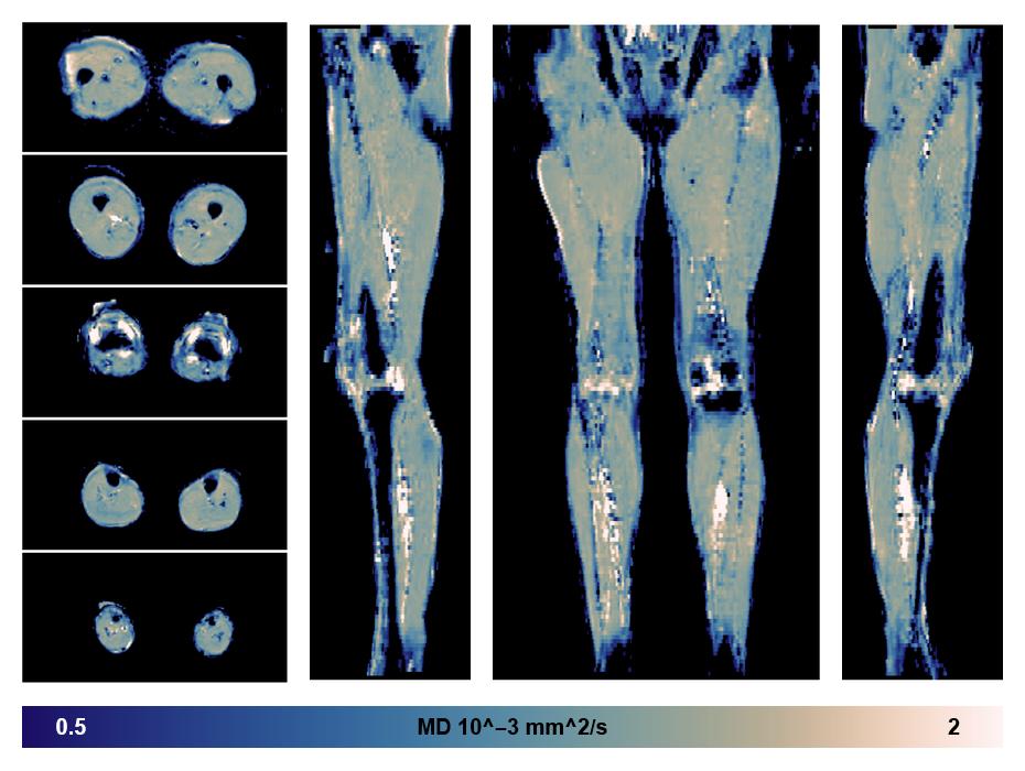 IVIM corrected whole leg muscle mean diffusivity obtained from diffusion tensor imaging.