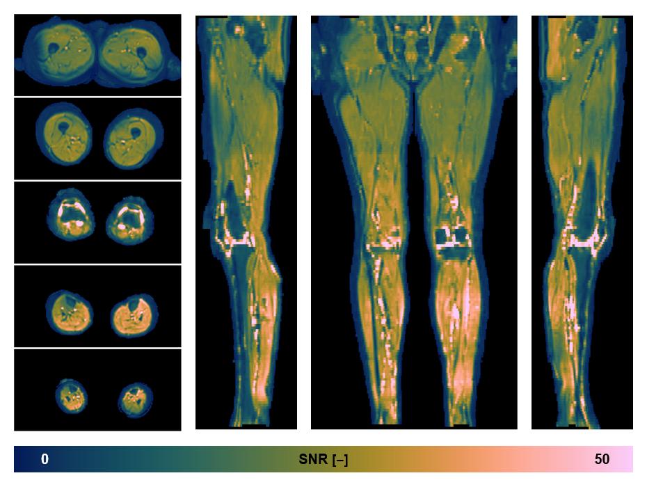 SNR distribution of the unweighted diffusion data.