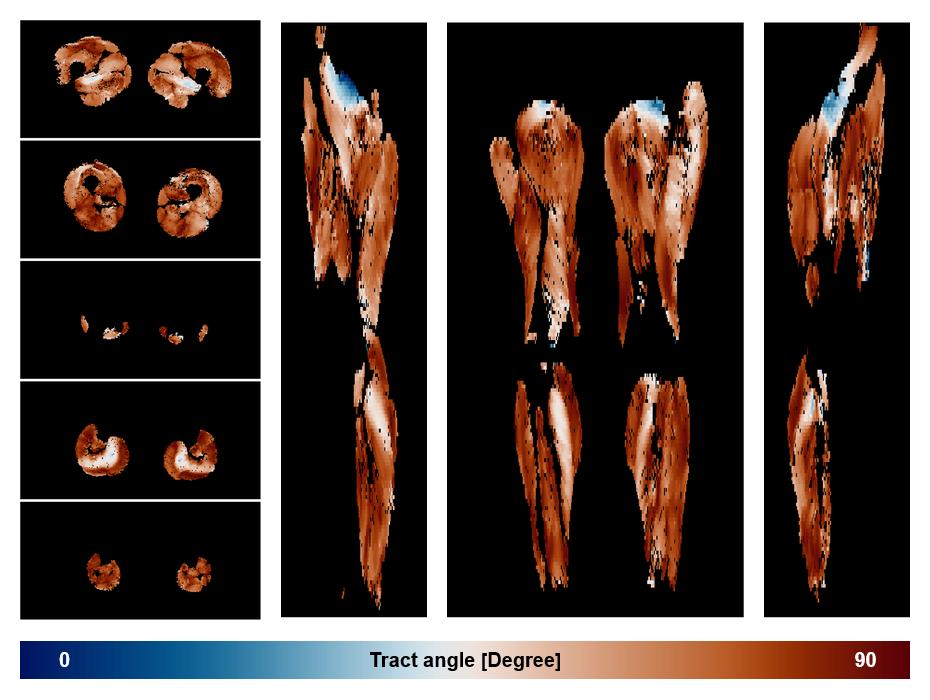 Muscle fiber tract angle map based on whole leg DTI based fiber tractography.