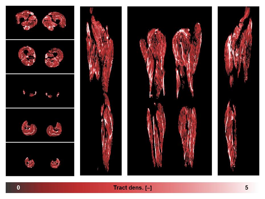 Muscle fiber tract density map based on whole leg DTI based fiber tractography.