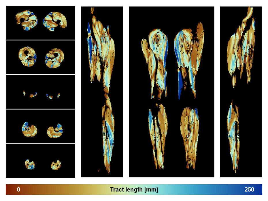 Muscle fiber tract length map based on whole leg DTI based fiber tractography.