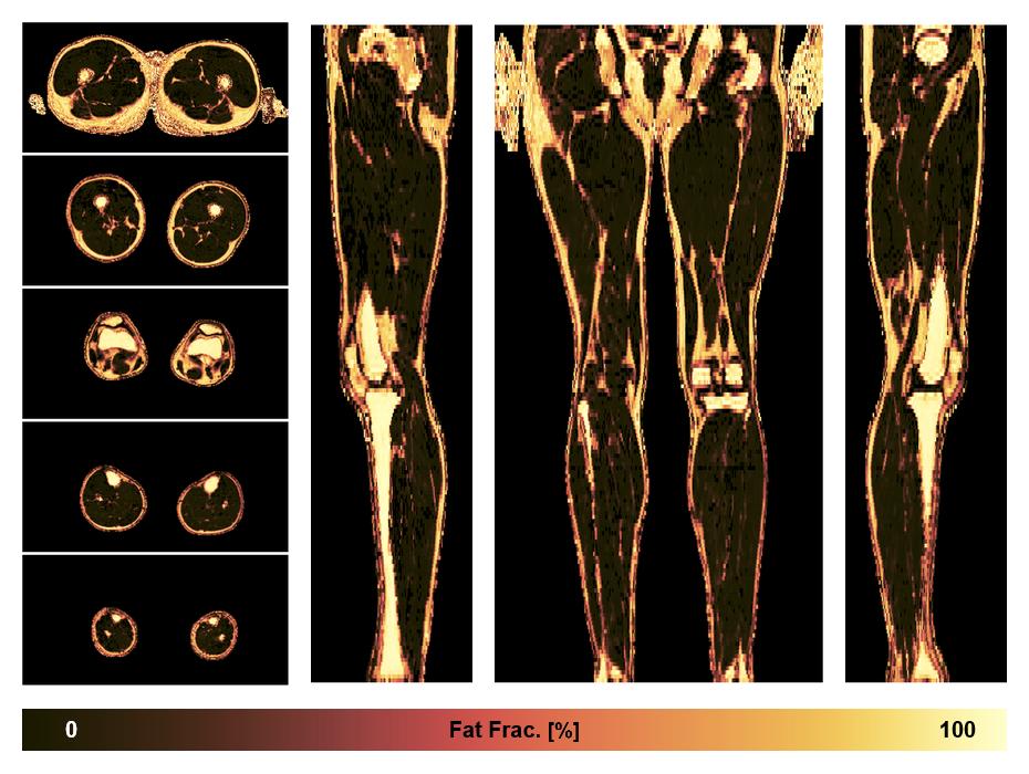 The fat fraction of the lower extremity obtained from the dixon reconstruction for muscle water fat quantification.