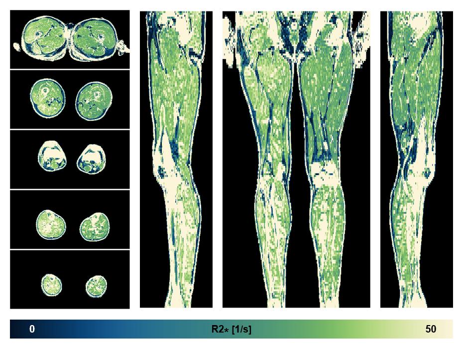 The R2 star relaxation time of the lower extremity obtained from the dixon reconstruction for muscle water fat quantification.