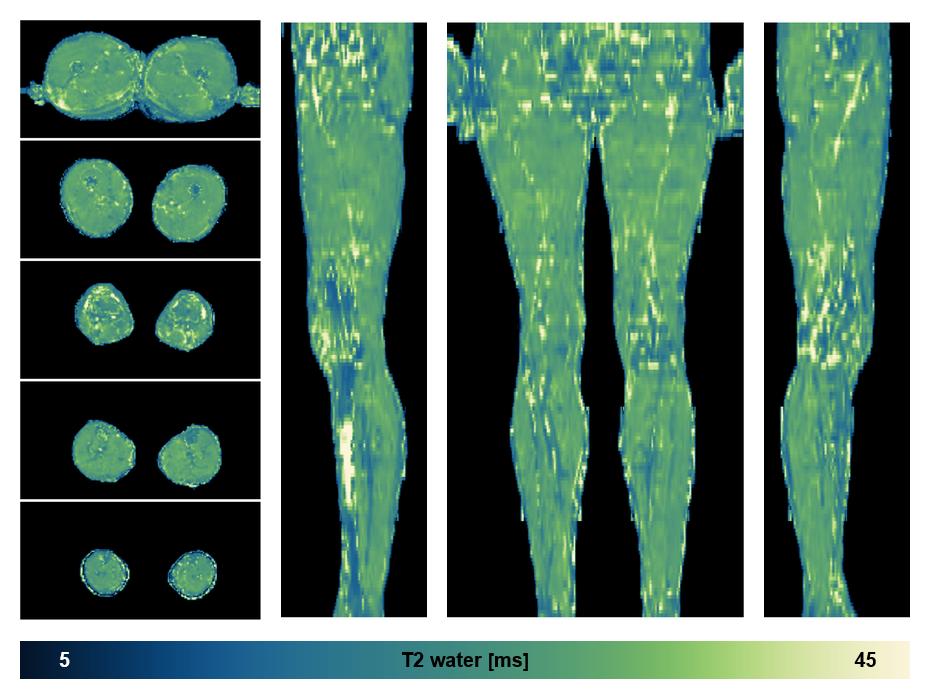 The water only T2 relaxation time of the lower extremity obtained from multi echo spin echo t2 mapping with EPG based reconstruction.