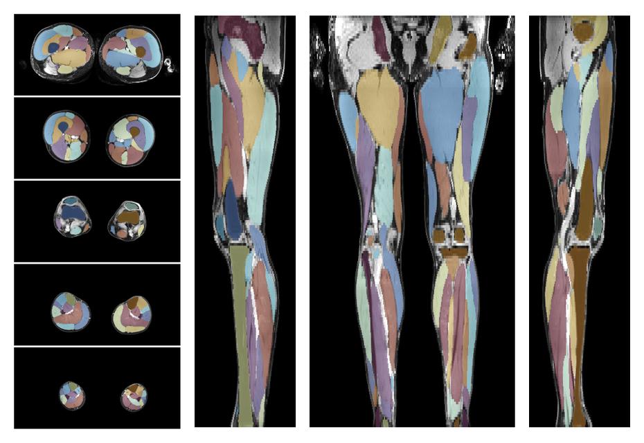 Overlay of automated muscle segmentation labels on dixon water image.