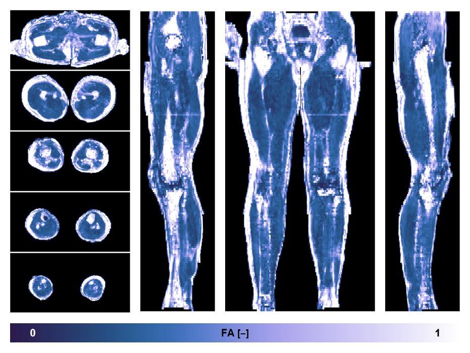 IVIM corrected whole leg muscle fractional anisotropy obtained from diffusion tensor imaging.