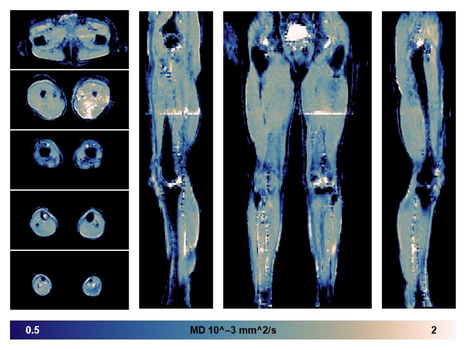 IVIM corrected whole leg muscle mean diffusivity obtained from diffusion tensor imaging.