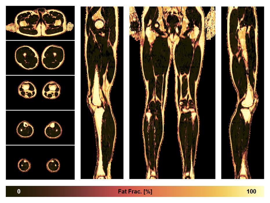 The fat fraction of the lower extremity obtained from the dixon reconstruction for muscle water fat quantification.