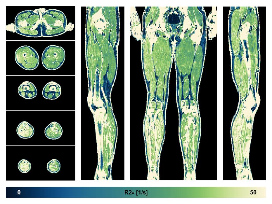 The R2 star relaxation time of the lower extremity obtained from the dixon reconstruction for muscle water fat quantification.