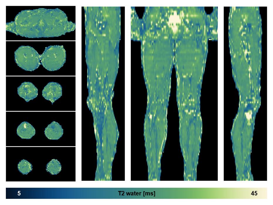 The water only T2 relaxation time of the lower extremity obtained from multi echo spin echo t2 mapping with EPG based reconstruction.
