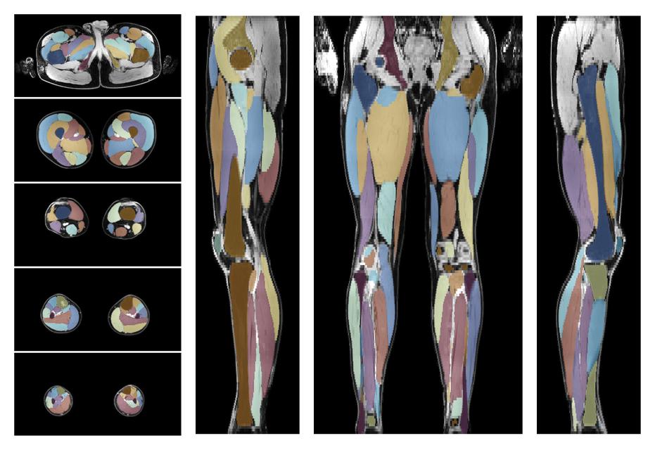 Overlay of automated muscle segmentation labels on dixon water image.