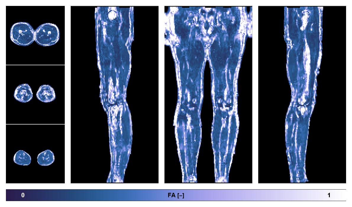 IVIM corrected whole leg muscle fractional anisotropy obtained from diffusion tensor imaging.