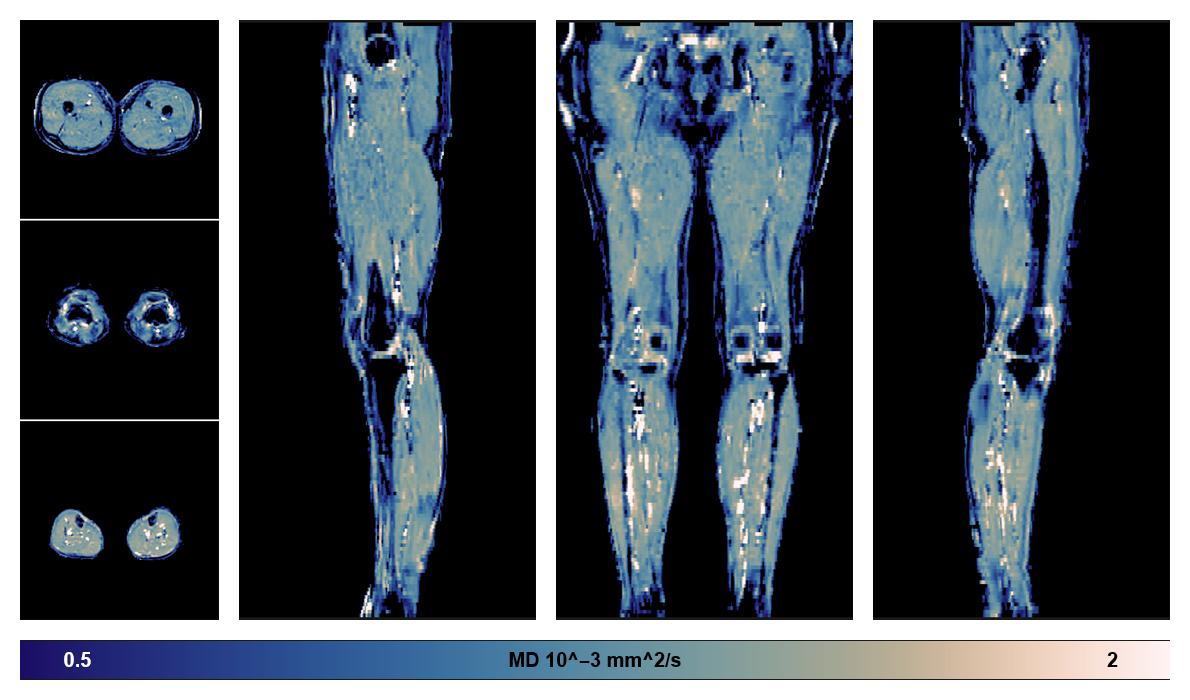 IVIM corrected whole leg muscle mean diffusivity obtained from diffusion tensor imaging.
