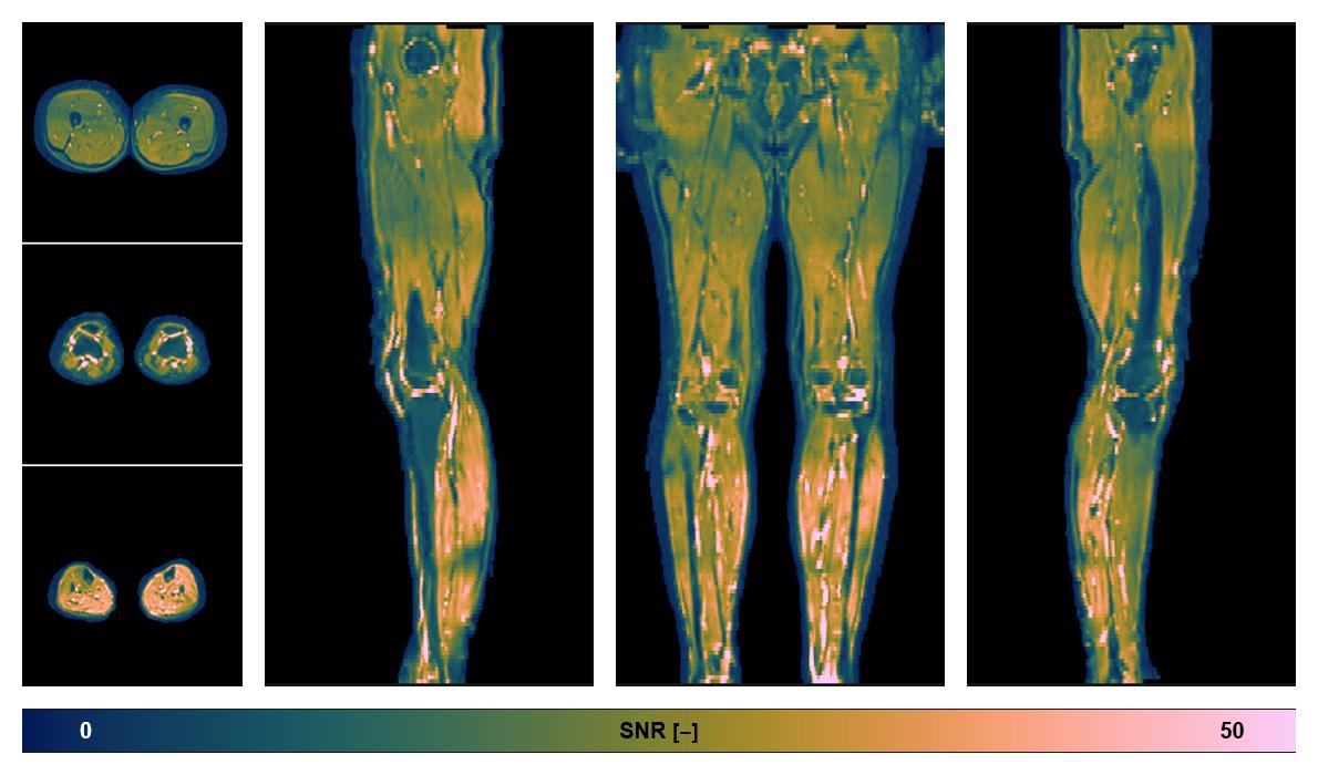 SNR distribution of the unweighted diffusion data.