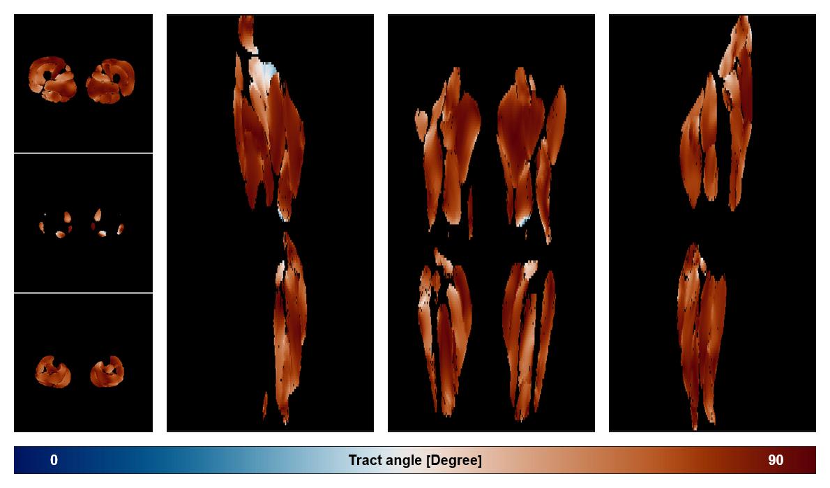 Muscle fiber tract angle map based on whole leg DTI based fiber tractography.