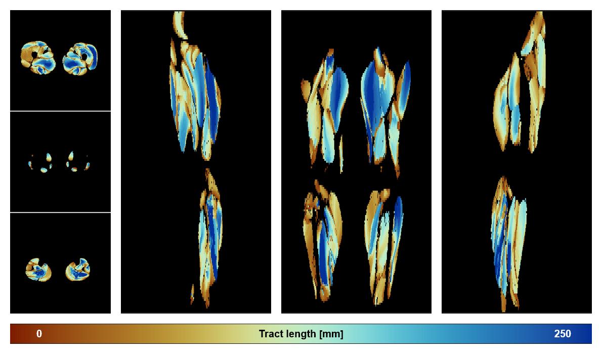Muscle fiber tract length map based on whole leg DTI based fiber tractography.
