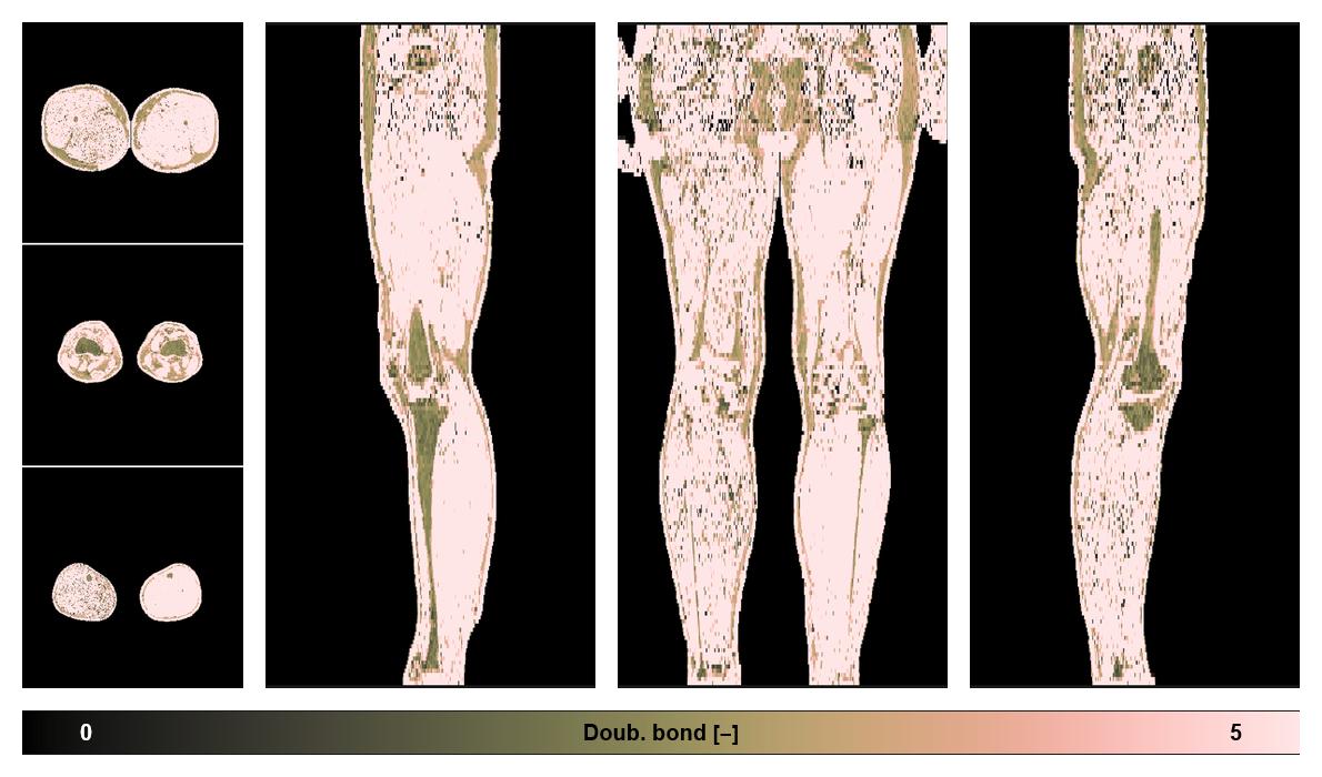 Number of double bonds in subcutanious fat.