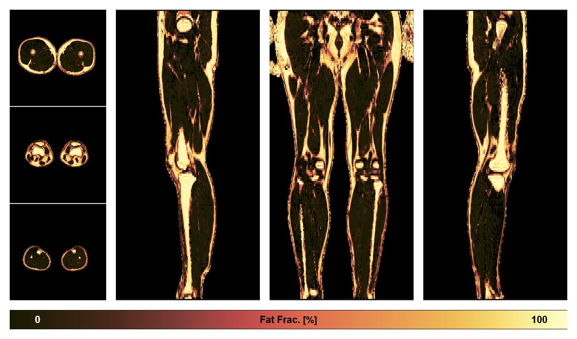 The fat fraction of the lower extremity obtained from the dixon reconstruction for muscle water fat quantification.