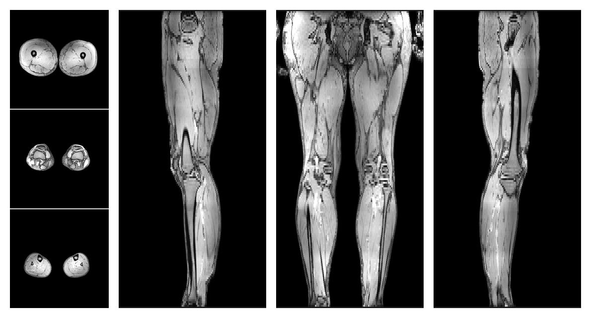 The out-phase image of the dixon reconstruction for water fat quantification.