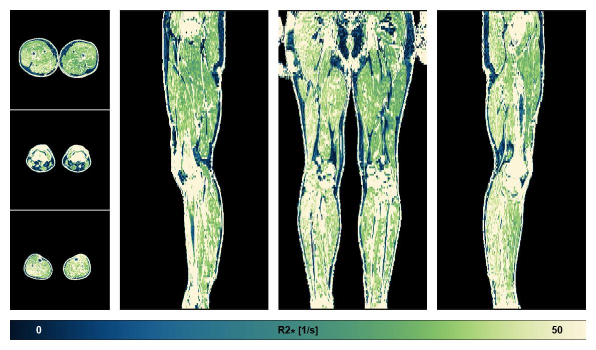 The R2 star relaxation time of the lower extremity obtained from the dixon reconstruction for muscle water fat quantification.
