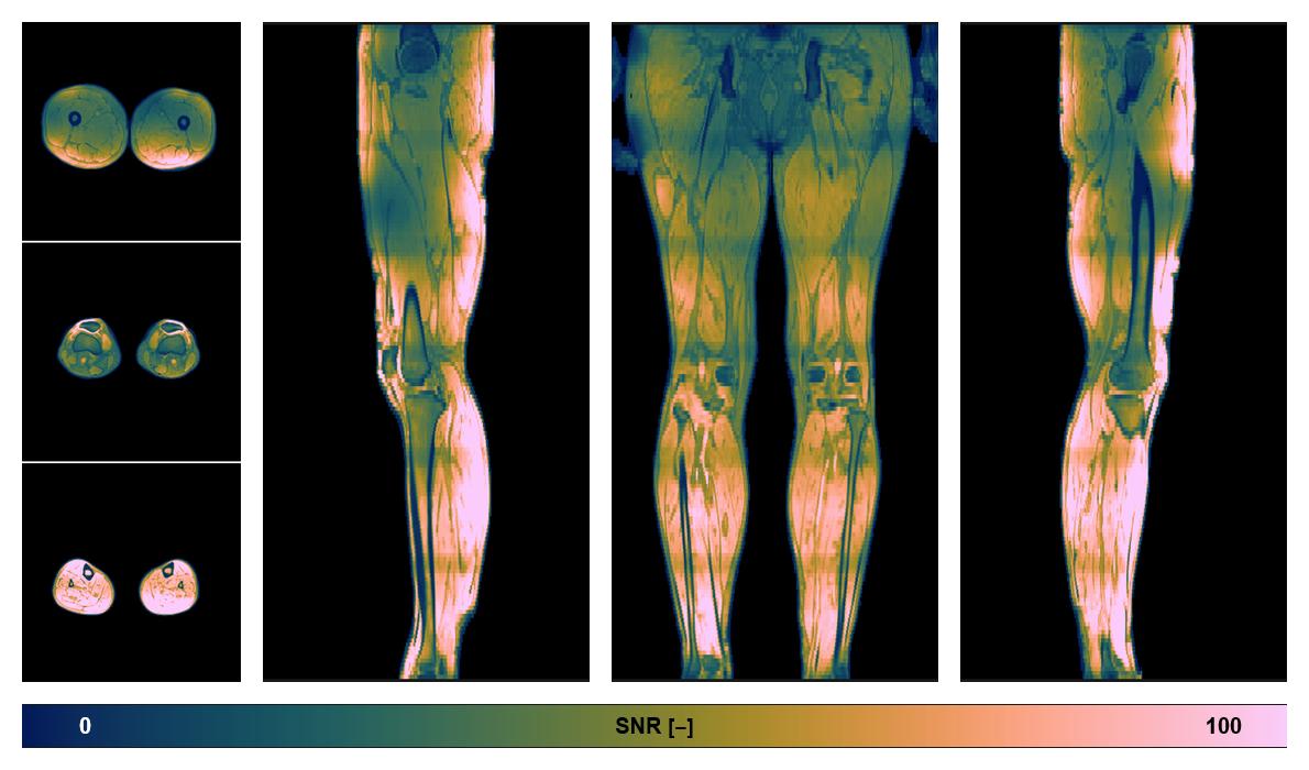 The SNR distribution of the dixon data.