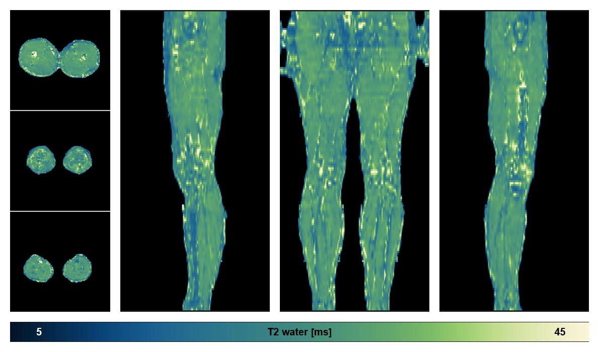 The water only T2 relaxation time of the lower extremity obtained from multi echo spin echo t2 mapping with EPG based reconstruction.