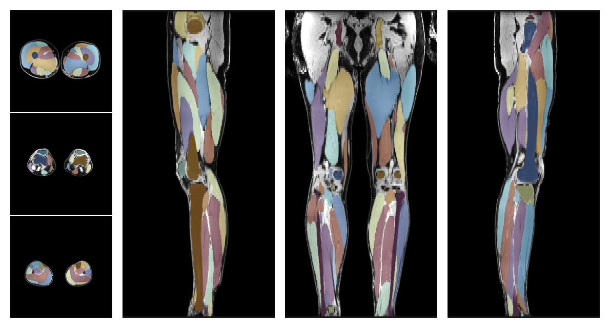 Overlay of automated muscle segmentation labels on dixon water image.
