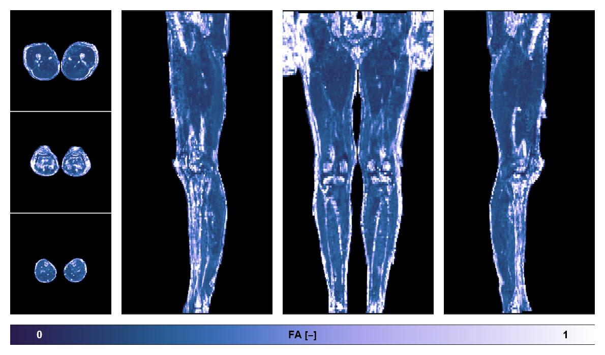 IVIM corrected whole leg muscle fractional anisotropy obtained from diffusion tensor imaging.
