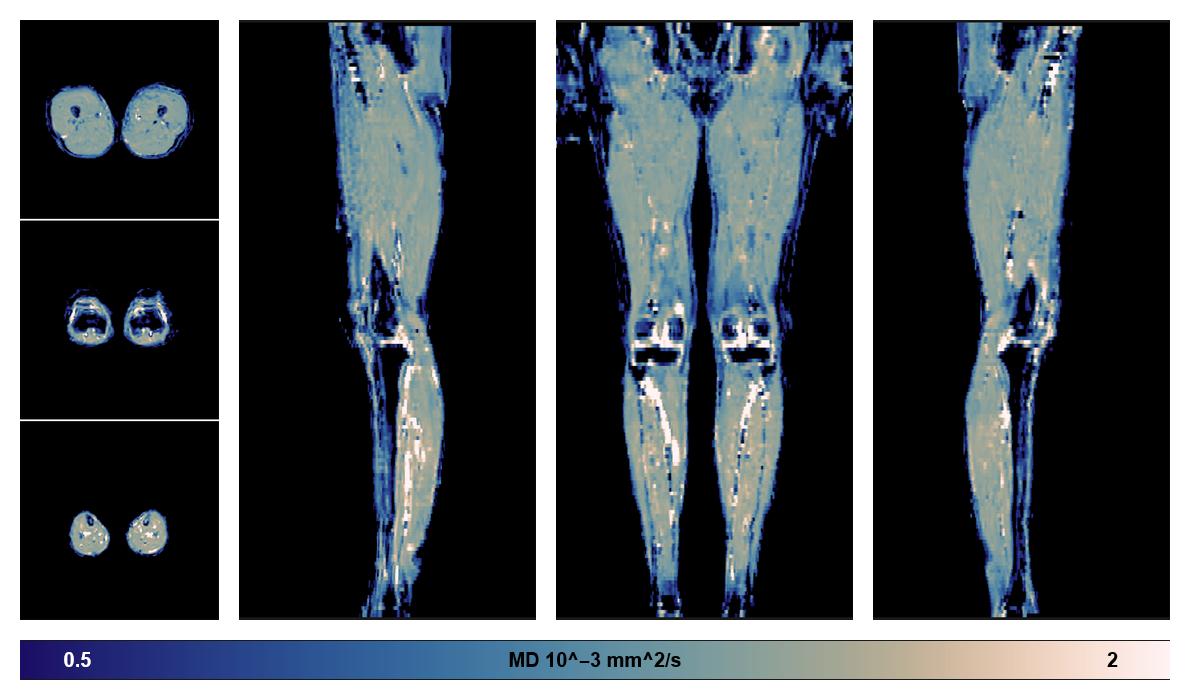 IVIM corrected whole leg muscle mean diffusivity obtained from diffusion tensor imaging.