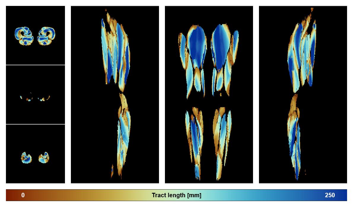 Muscle fiber tract length map based on whole leg DTI based fiber tractography.