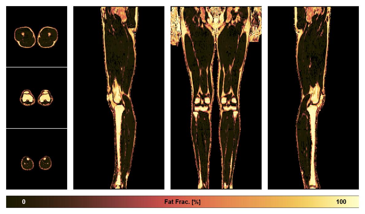 The fat fraction of the lower extremity obtained from the dixon reconstruction for muscle water fat quantification.
