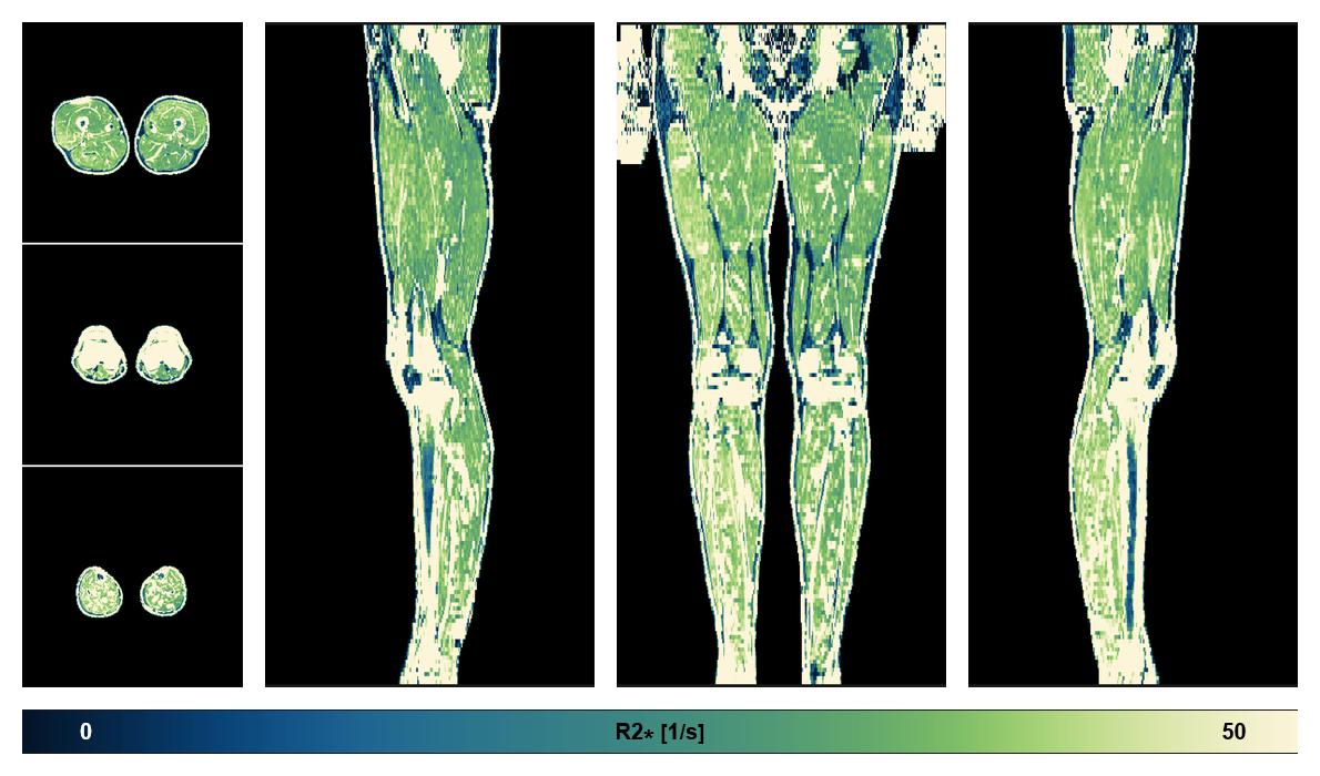 The R2 star relaxation time of the lower extremity obtained from the dixon reconstruction for muscle water fat quantification.