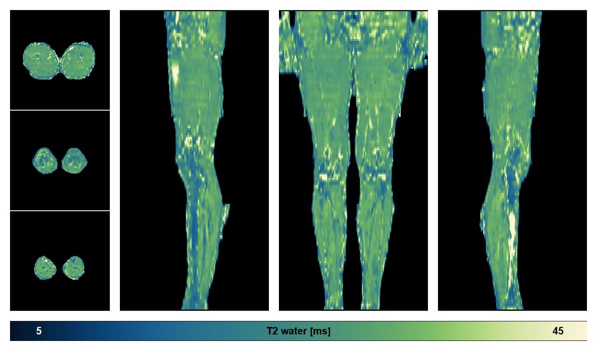 The water only T2 relaxation time of the lower extremity obtained from multi echo spin echo t2 mapping with EPG based reconstruction.