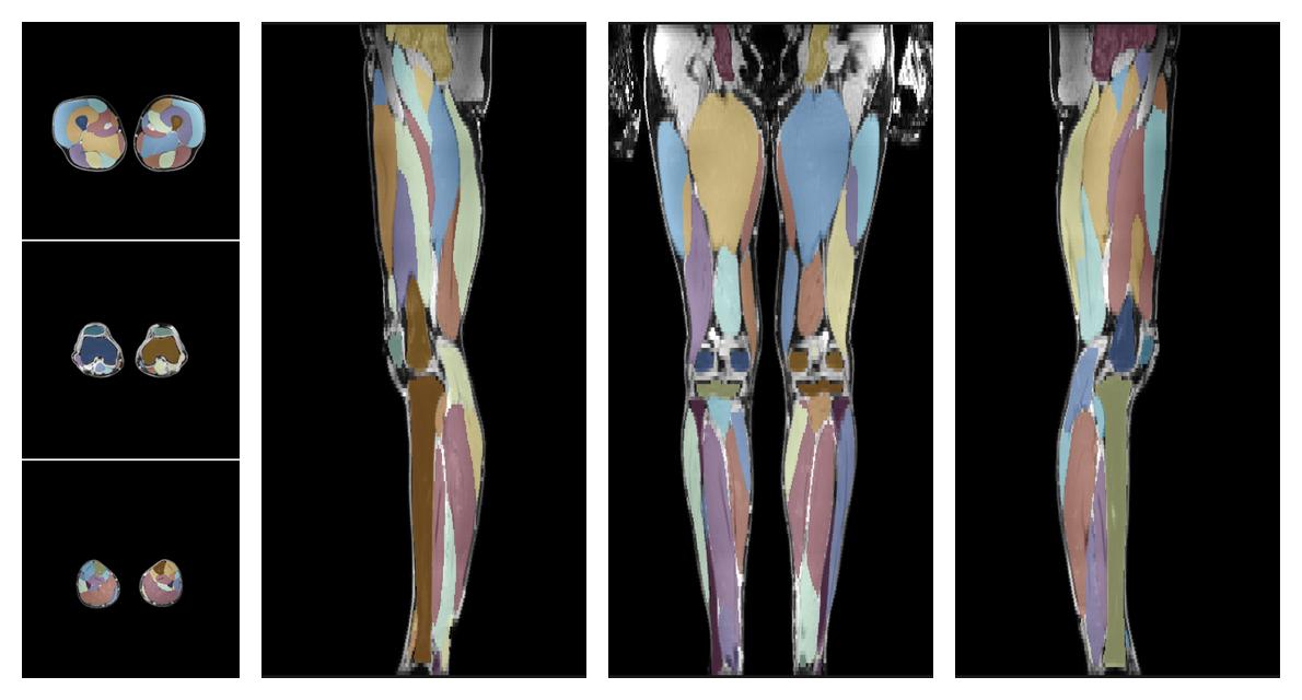 Overlay of automated muscle segmentation labels on dixon water image.