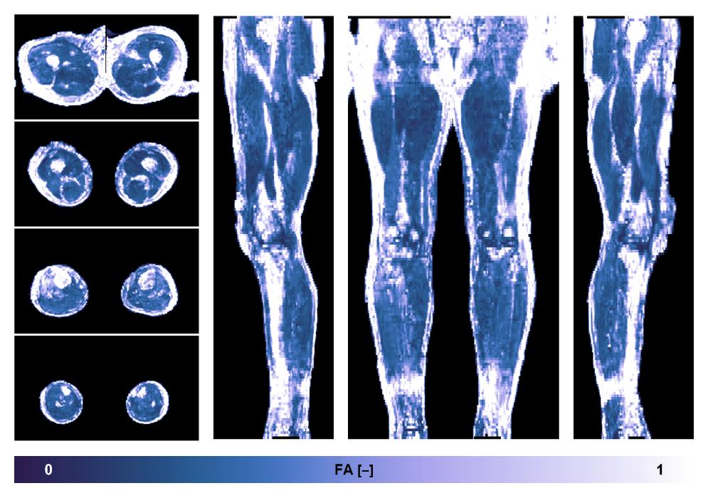 IVIM corrected whole leg muscle fractional anisotropy obtained from diffusion tensor imaging.