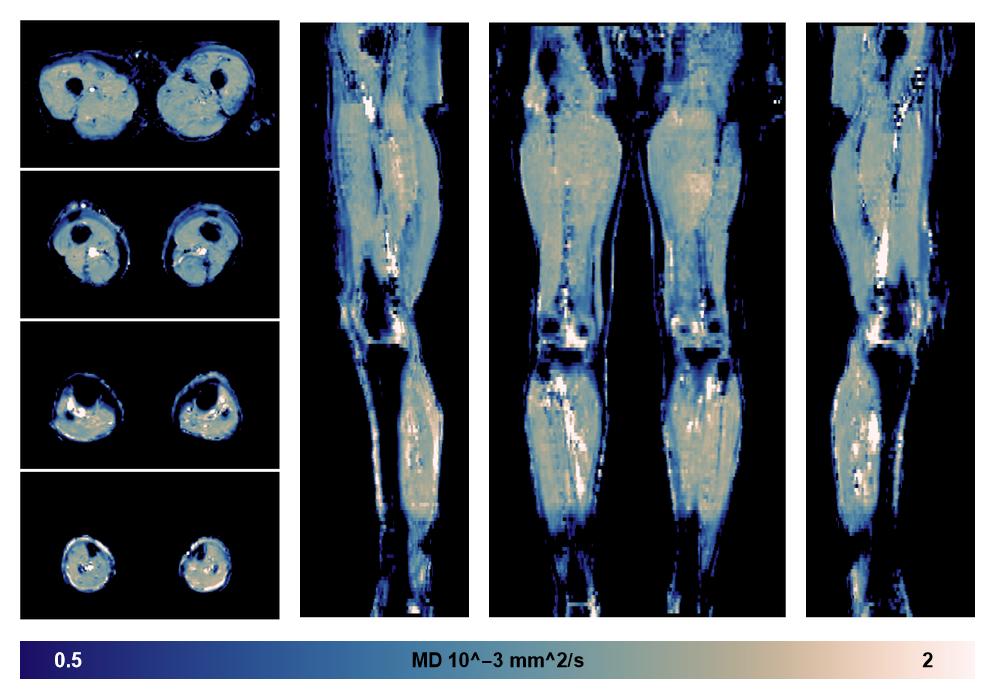 IVIM corrected whole leg muscle mean diffusivity obtained from diffusion tensor imaging.