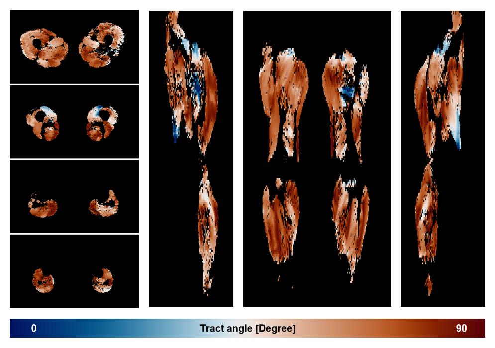 Muscle fiber tract angle map based on whole leg DTI based fiber tractography.