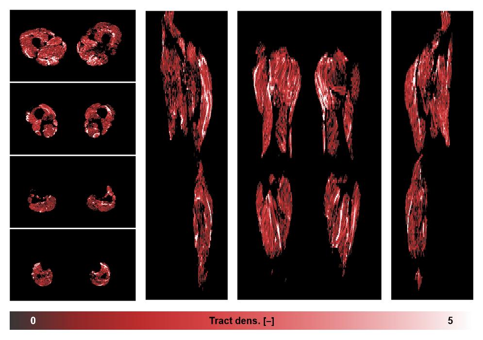 Muscle fiber tract density map based on whole leg DTI based fiber tractography.