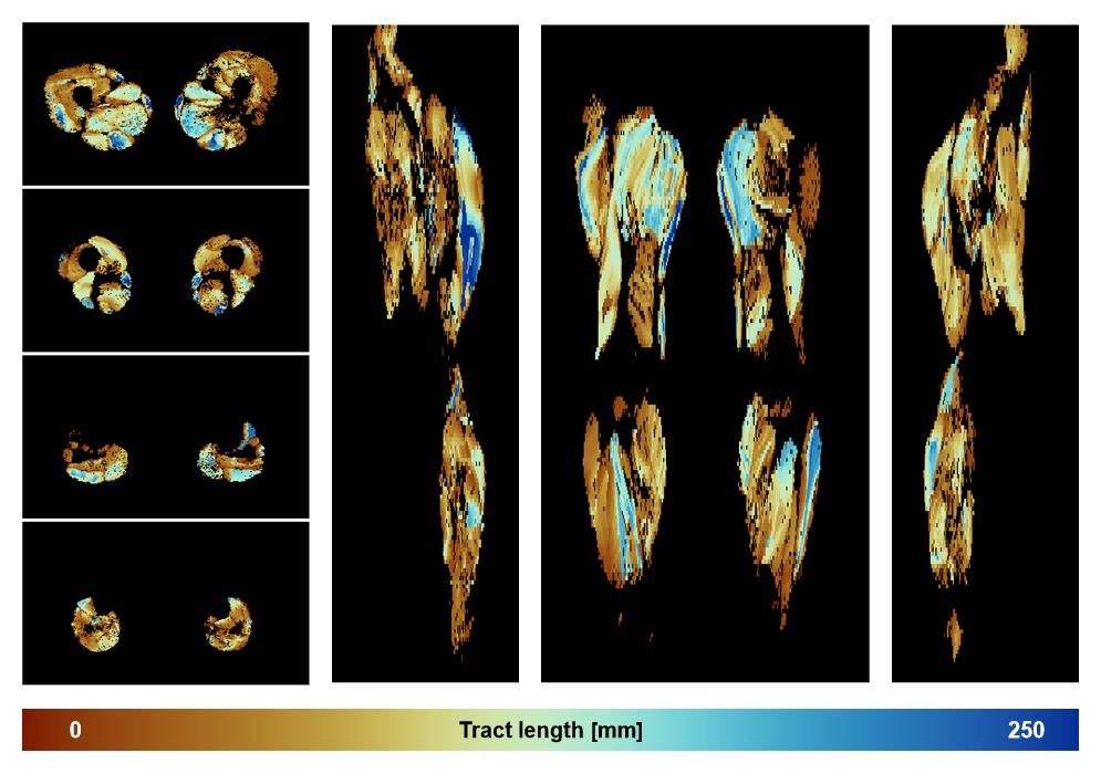 Muscle fiber tract length map based on whole leg DTI based fiber tractography.