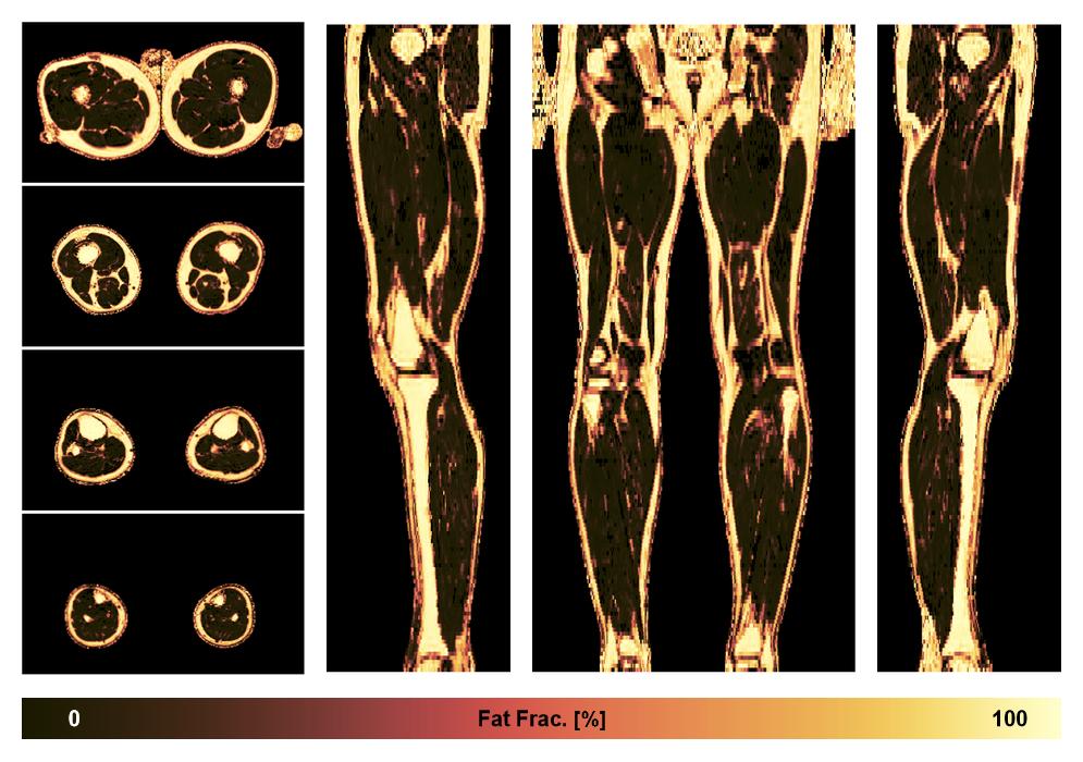 The fat fraction of the lower extremity obtained from the dixon reconstruction for muscle water fat quantification.