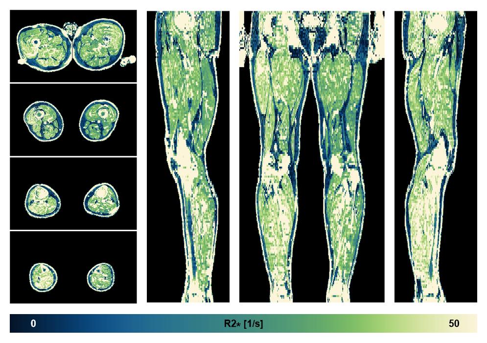 The R2 star relaxation time of the lower extremity obtained from the dixon reconstruction for muscle water fat quantification.
