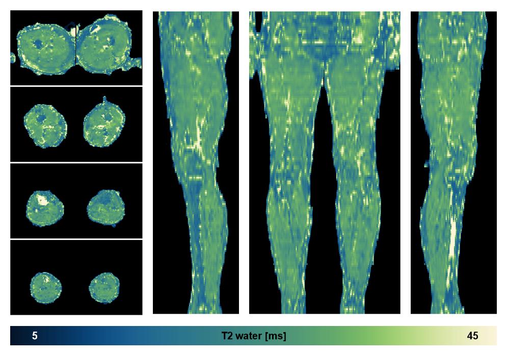 The water only T2 relaxation time of the lower extremity obtained from multi echo spin echo t2 mapping with EPG based reconstruction.